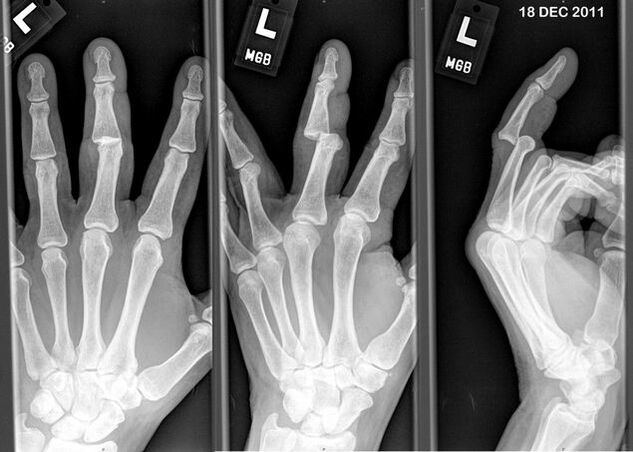 Çıkık parmakların röntgeni
