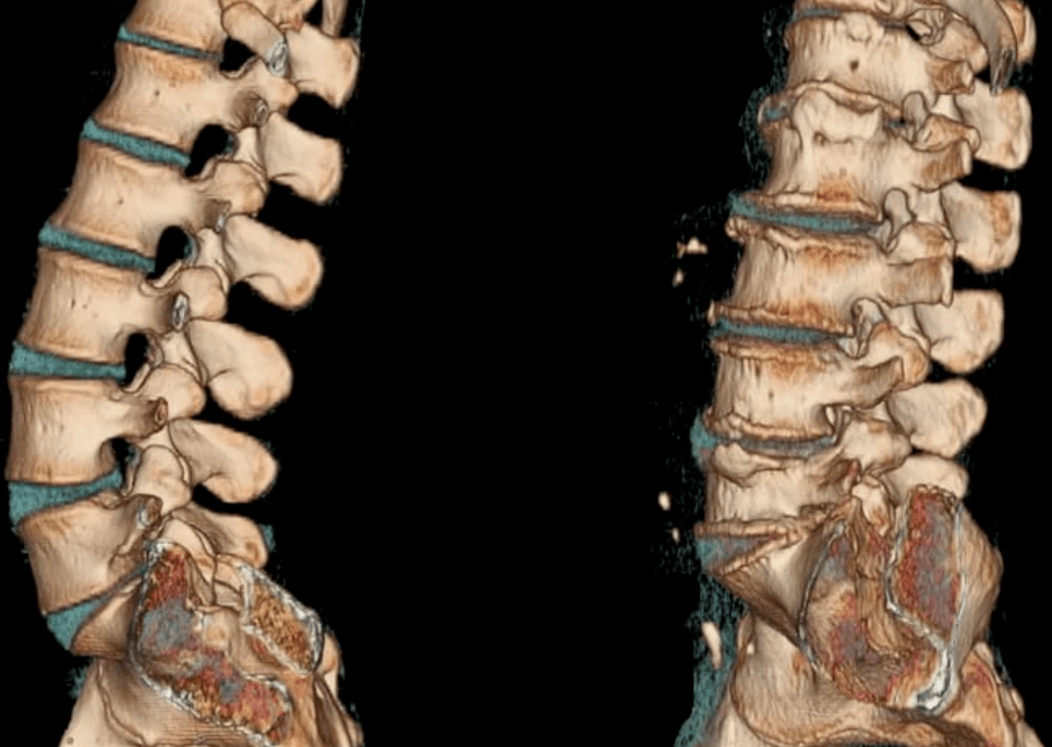 osteokondroz