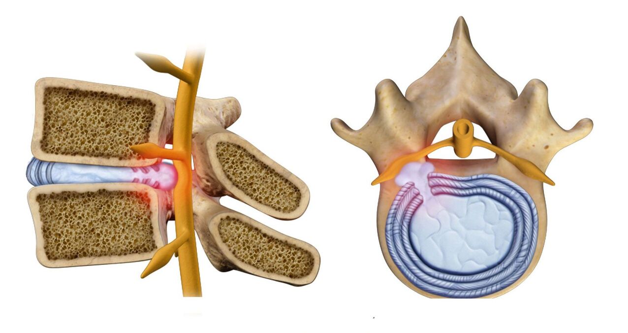 Torasik osteokondrozda spinal fıtık