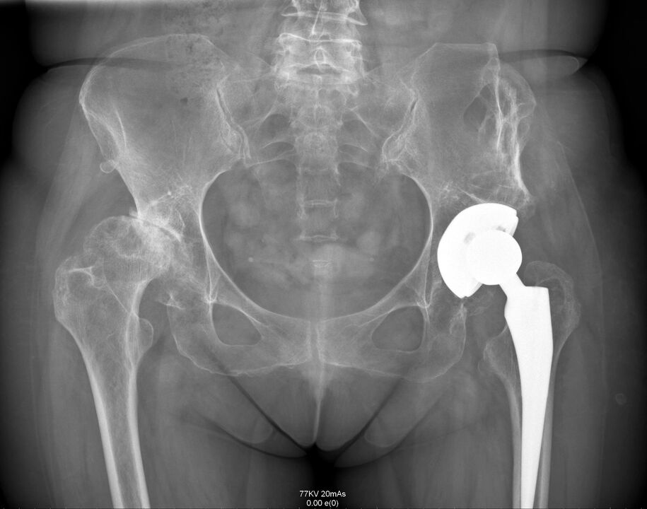 Artroplasti sonrası kalça ekleminin röntgeni