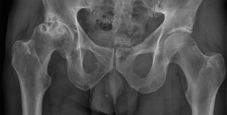 Röntgende kalça ekleminin deforme edici artrozu