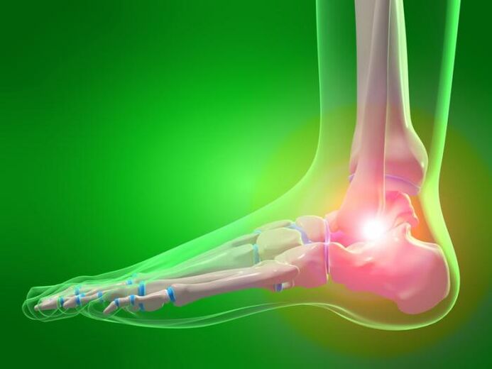 artrozlu ayak bileği ekleminin iltihabı