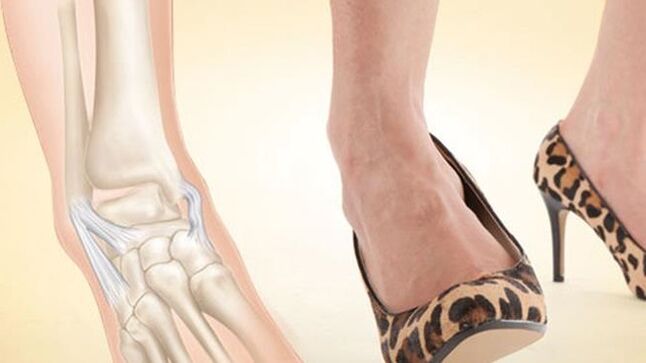 ayak bileği artrozunun bir nedeni olarak topuklu ayakkabı giymek