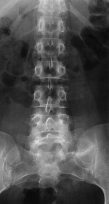 Lomber osteokondrozu teşhis etmek için radyografi yapılır
